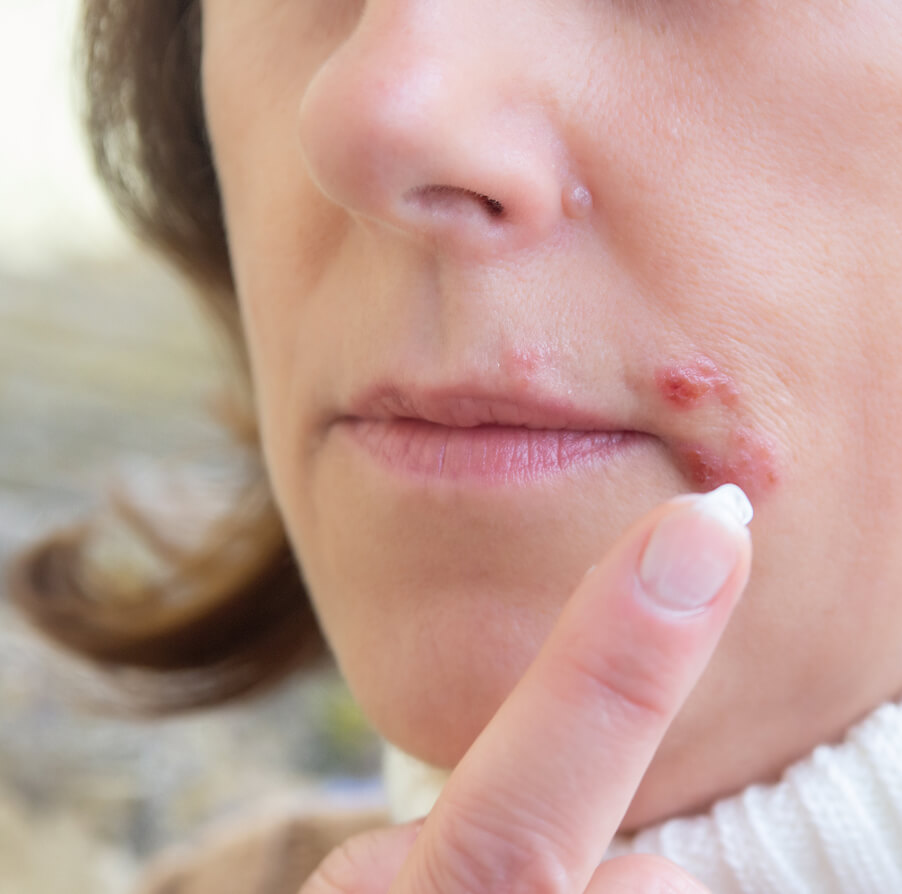 herpes-on-the-lips-part-of-a-woman-s-face-with-fi-2025-02-02-20-23-49-utc 1 (1)